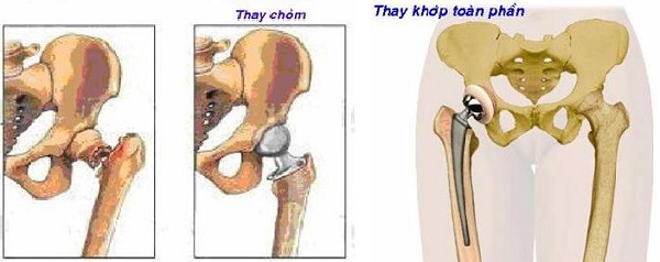 Femoral Fracture - Hình ảnh minh họa